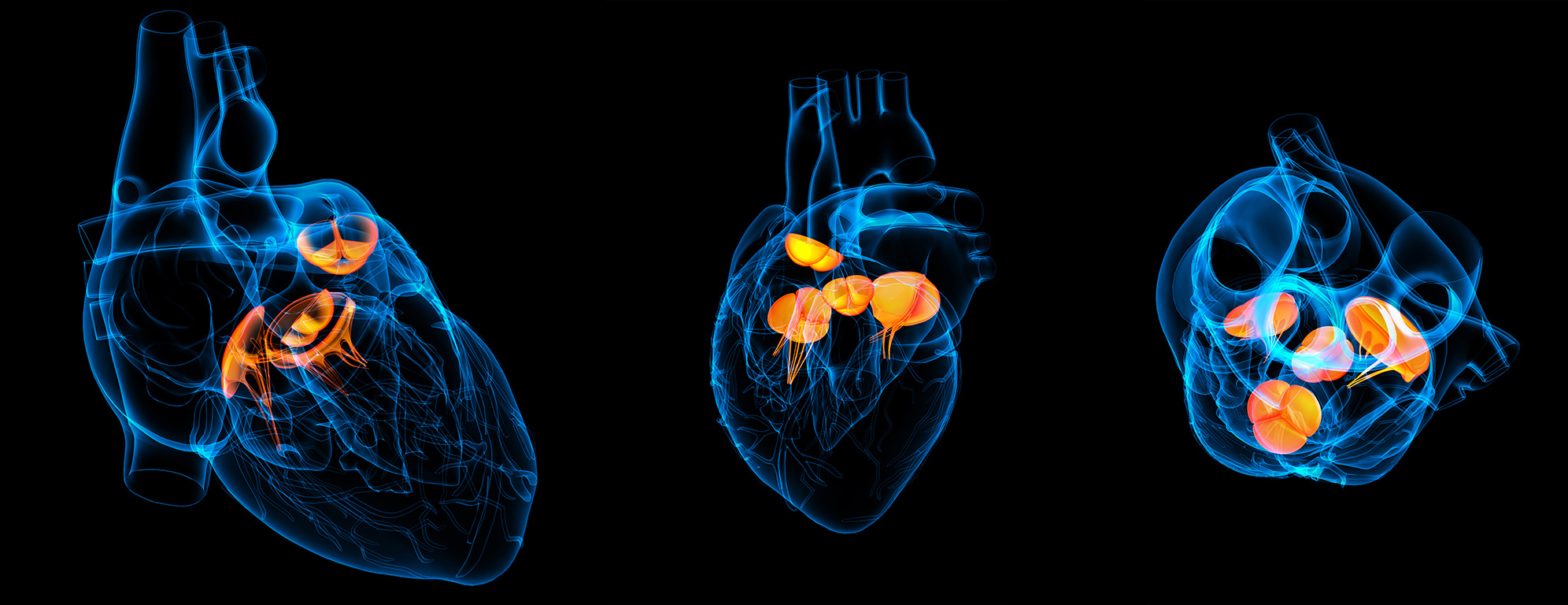 Augustinum Cardiology Academy Verschiedene Blickwinkel auf ein Herz mit einer Transkatheder-Aortenklappenimplantation